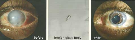 Corneal Transplant