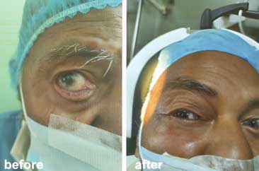 Surgically treated